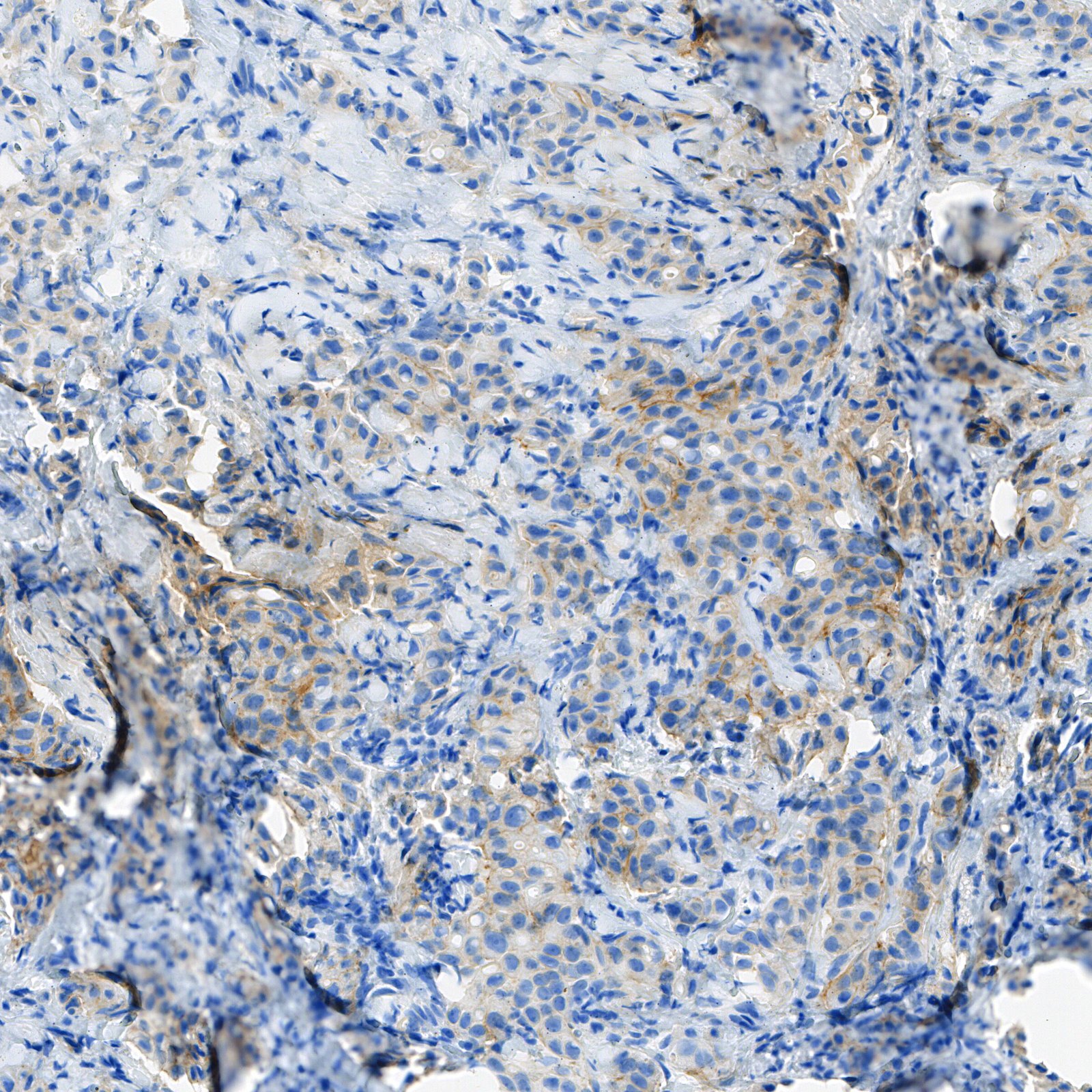 HER2 IHC 1+ 真实切片