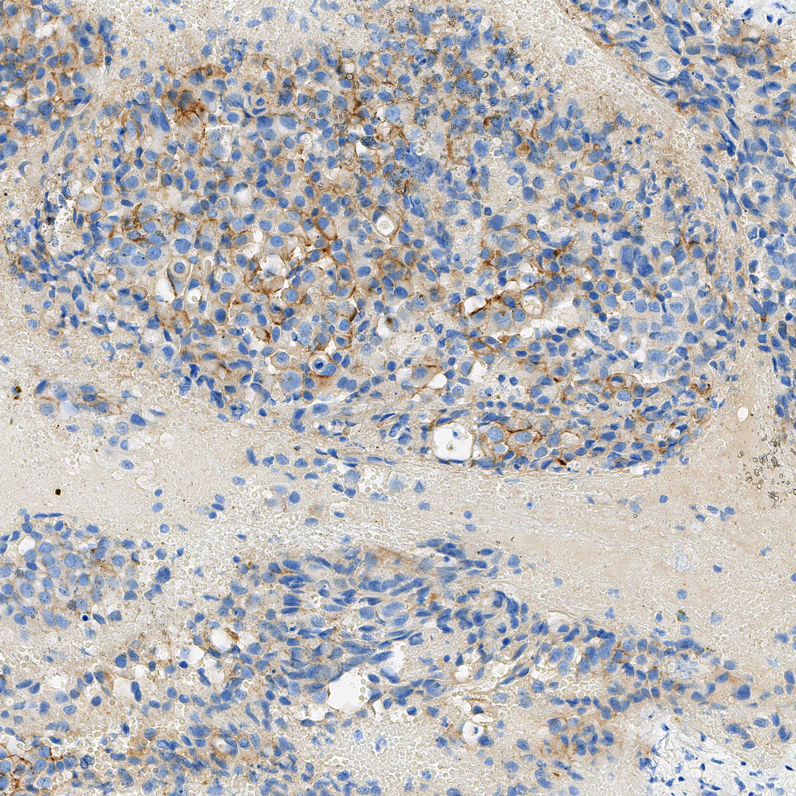 HER2 IHC 2+ 真实切片