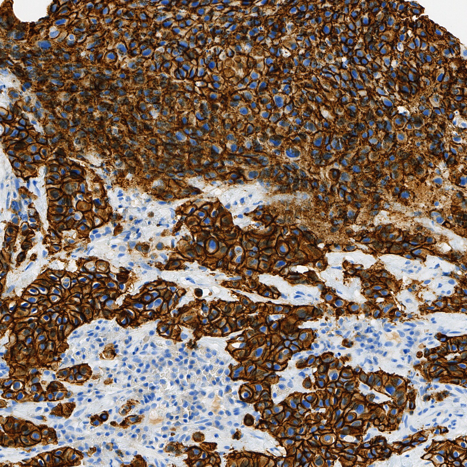 HER2 IHC 3+ 真实切片