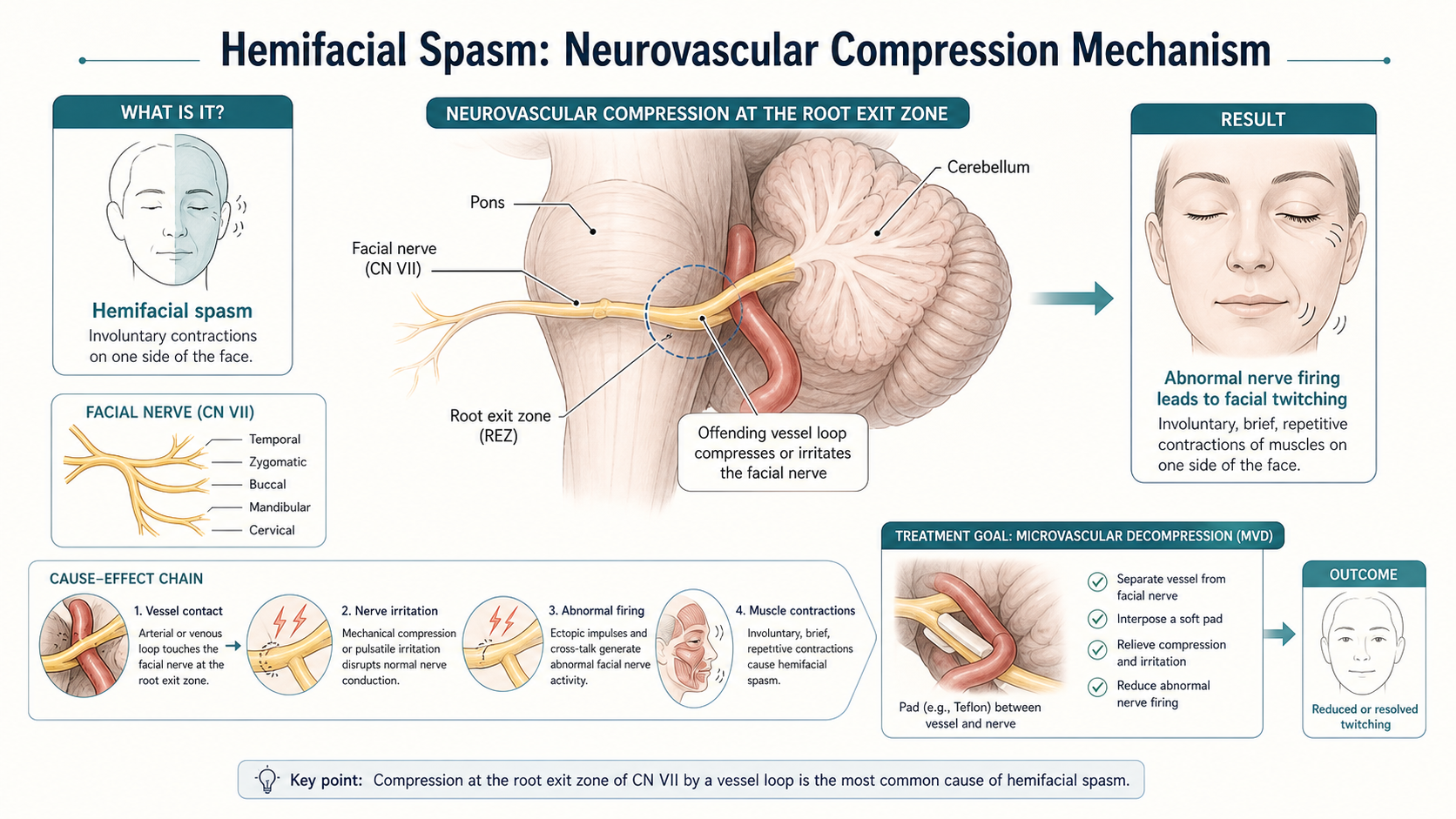 Hemifacial spasm neurovascular compression mechanism